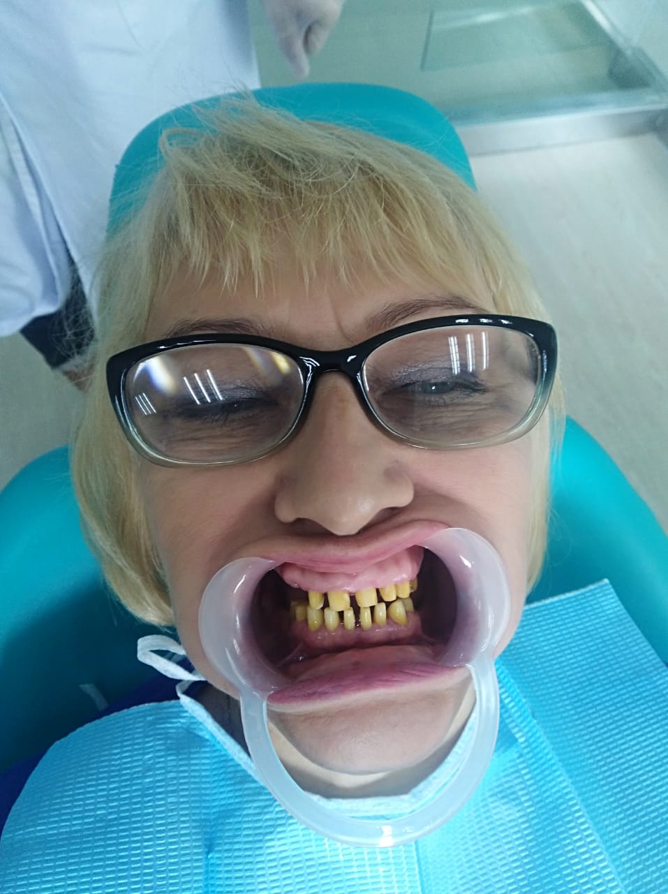 до протезировании зубов в Китае